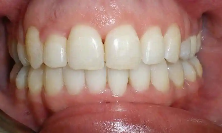 spacing of teeth after