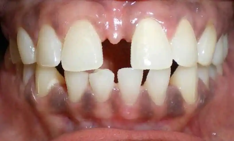 spacing of teeth before